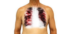 Human chest with x-ray shows cavity at right upper lung and interstitial infiltrate in both lungs due to infection. wishing he could be Interstitial Free. Isolated background .